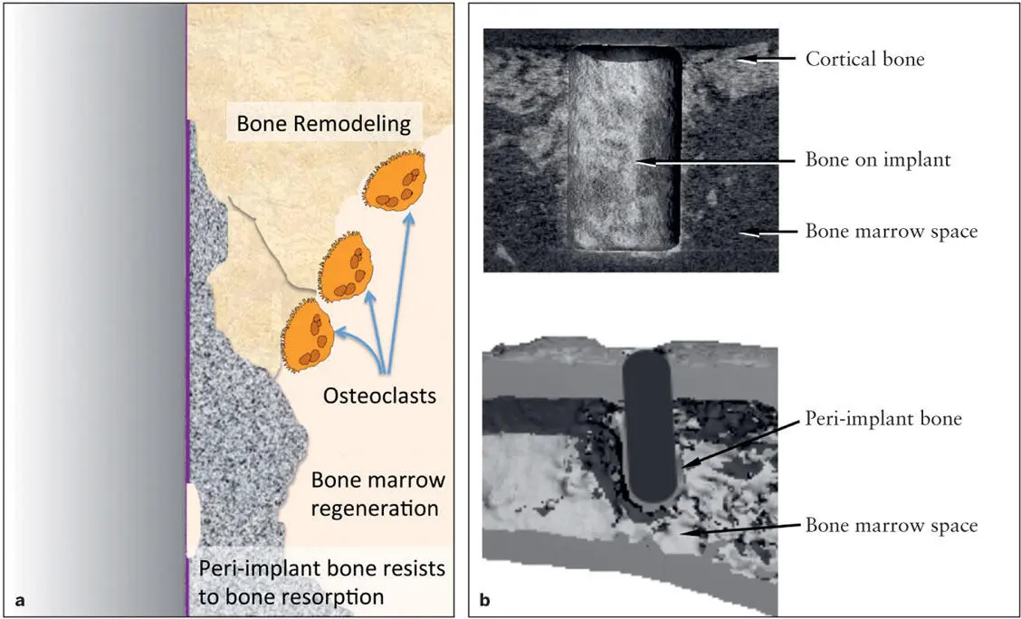 Fig 29 a A diagram of bone marrow ablation healing around an implant The - фото 35