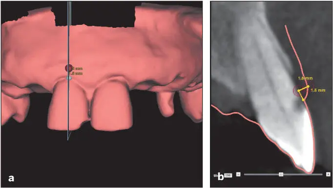 Fig 57 a and b This CBCT evaluation allows visualization of the overlying - фото 90