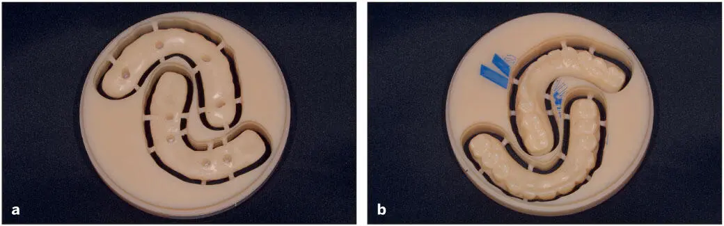 Fig 55 a and b Provisional fullarch prosthesis milled of PMMA Pucks are - фото 88