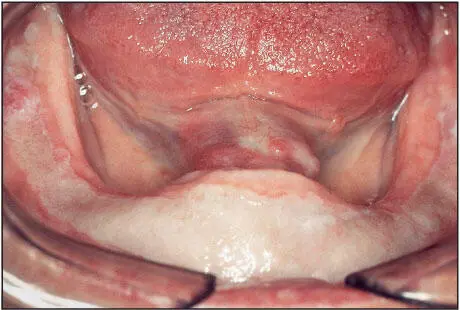 Fig 612 Patient with a skin graft vestibuloplasty The floor of the mouth was - фото 119