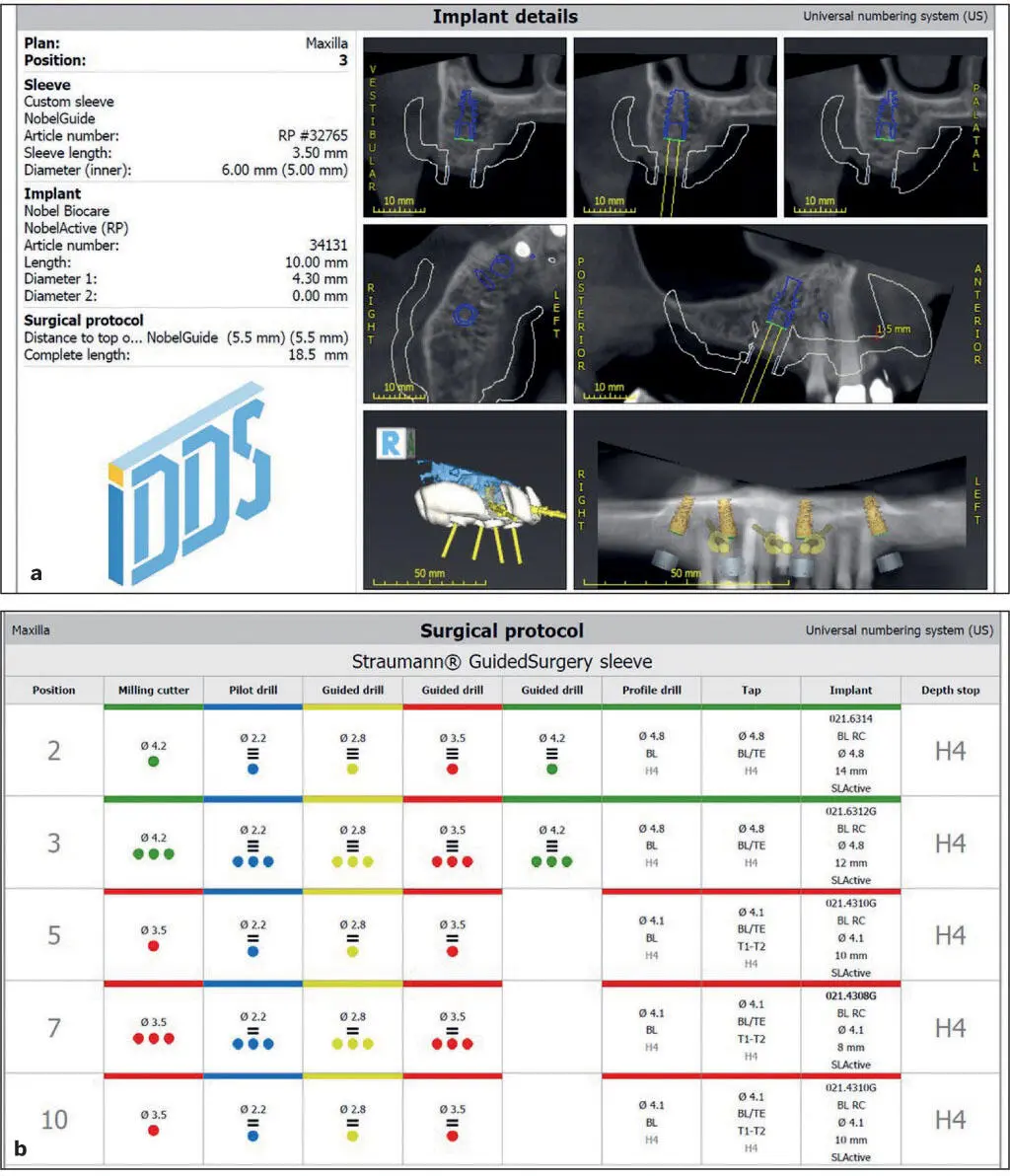Fig 517 An example of the guided implant surgery a Details of the planned - фото 101