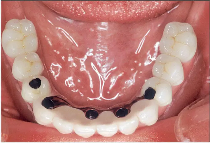 Fig 614 Implantsupported metalceramic fixed dental prosthesis Many patients - фото 121