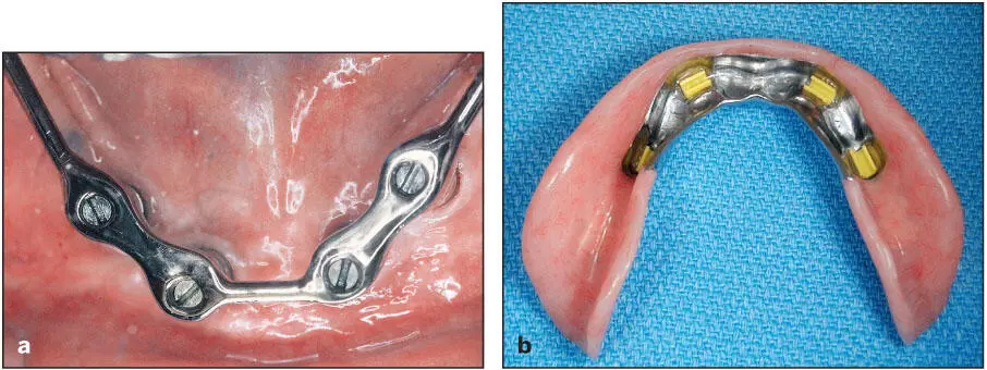 Fig 613 a and b Implantsupported overdenture All the forces of occlusion - фото 120