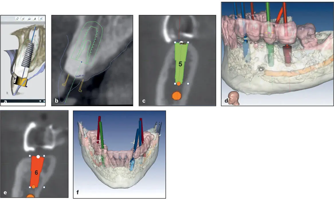 Fig 58 Virtual planning for immediate implant positioning a and b In the - фото 91