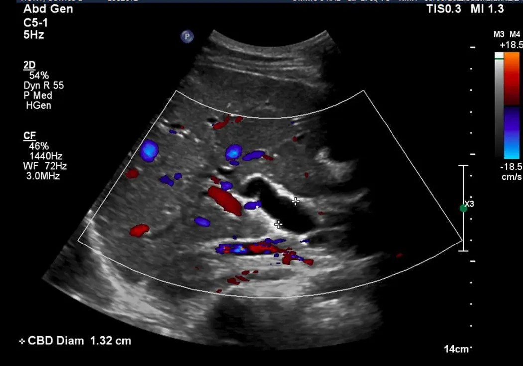 FIGURE 110 Ultrasound of right upper quadrant static image showing biliary - фото 12
