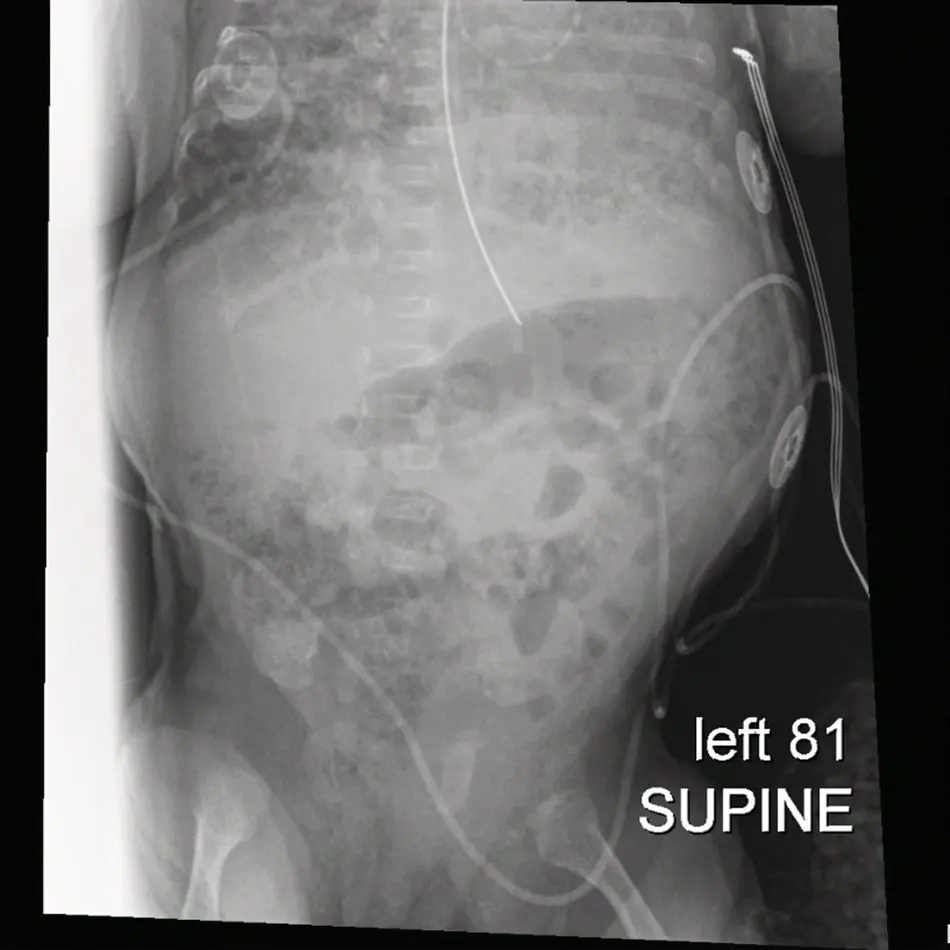 FIGURE 11 Abdominal xray showing distended bowel with early intraluminal gas - фото 3