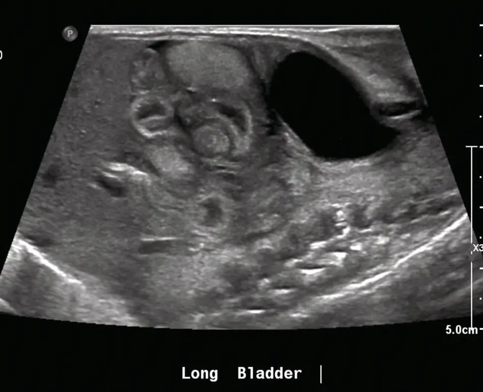 FIGURE 12 Abdominal ultrasound showing pneumatosis FIGURE 13 - фото 4