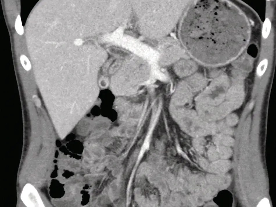 FIGURE 112 Computed tomography of the abdomenpelvis with intravenous contrast - фото 14