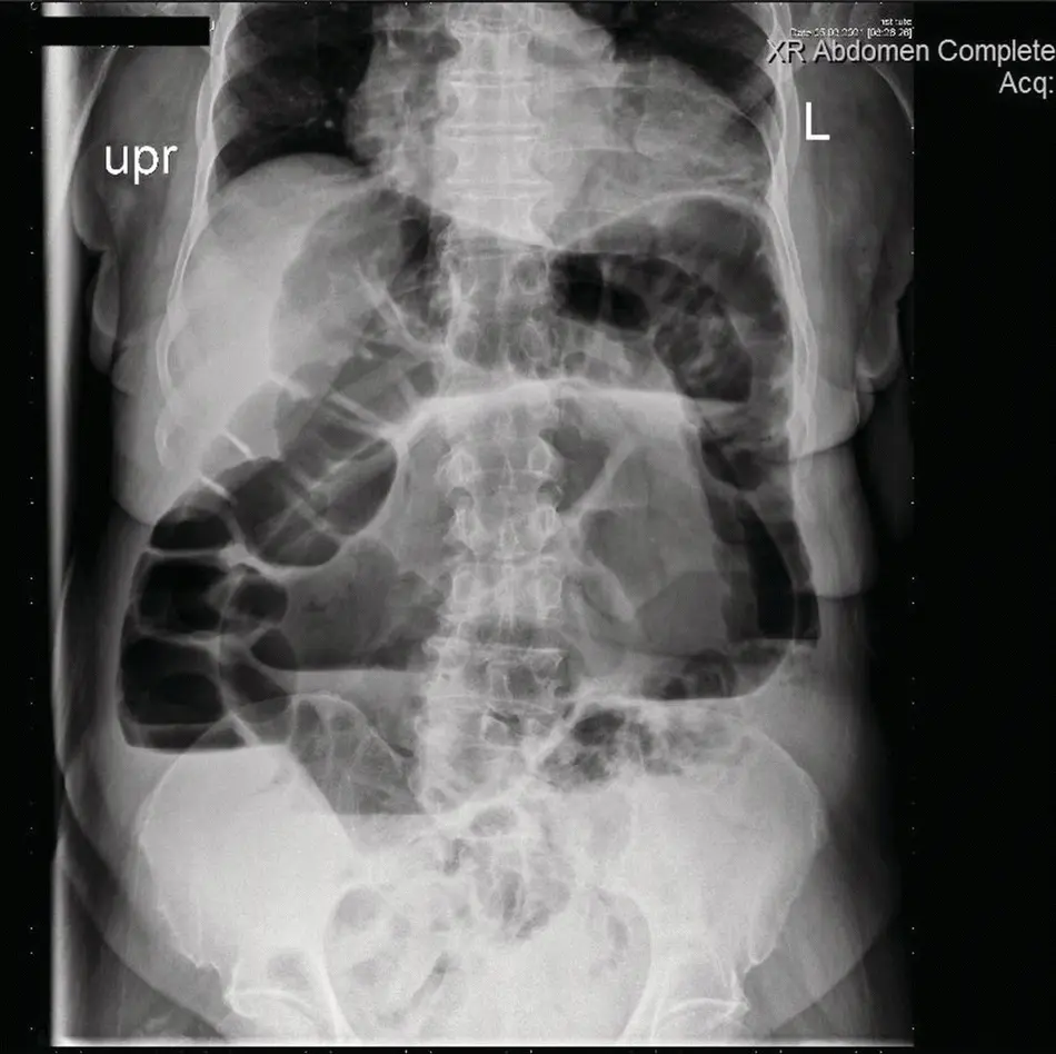FIGURE 116 Abdominal xray showing evidence of distended sigmoid colon - фото 18