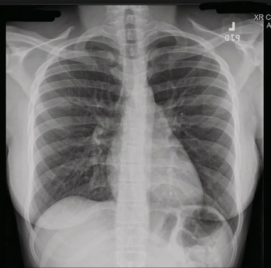 FIGURE 16 Chest xray showing no active pulmonary disease FIGURE 17 - фото 8