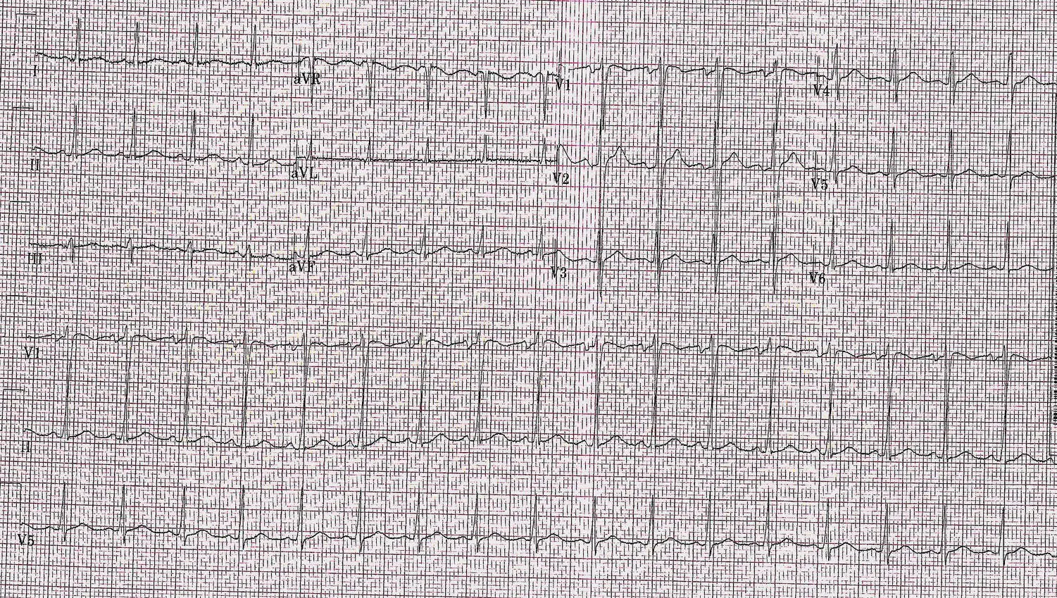 FIGURE 114 Electrocardiogram showing sinus tachycardia FIGURE 115 Flow - фото 16