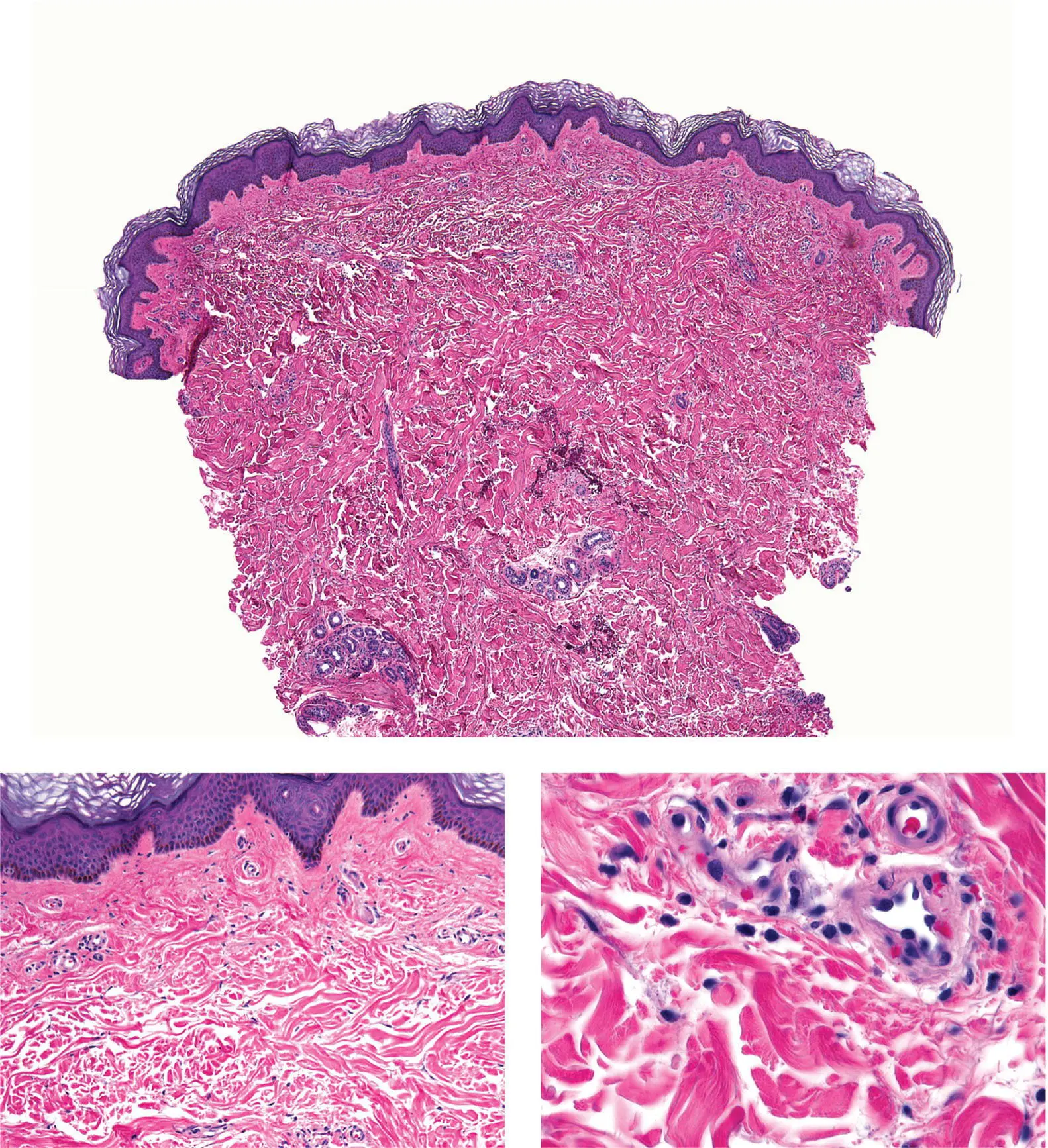 Figure 5D Urticaria Urticaria can appear normal at low power particularly - фото 22