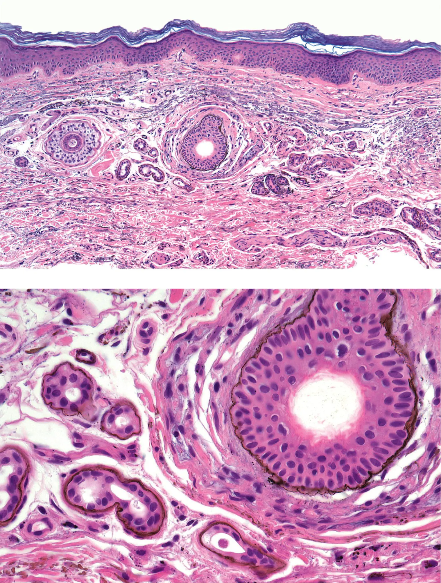 Figure 5A Argyria There are fine black granules in the basement membrane of - фото 19