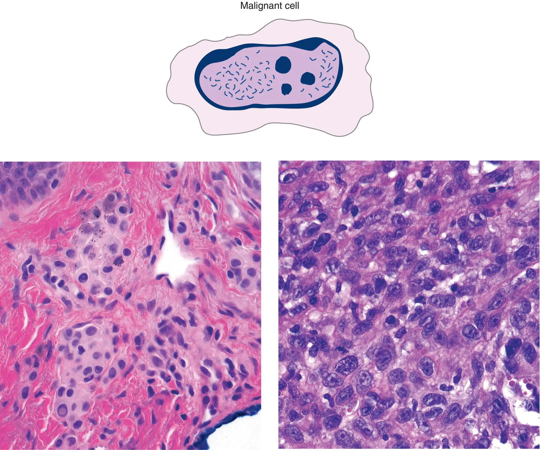 Figure 2DCytologic features are important in pointing toward a benign versus - фото 11