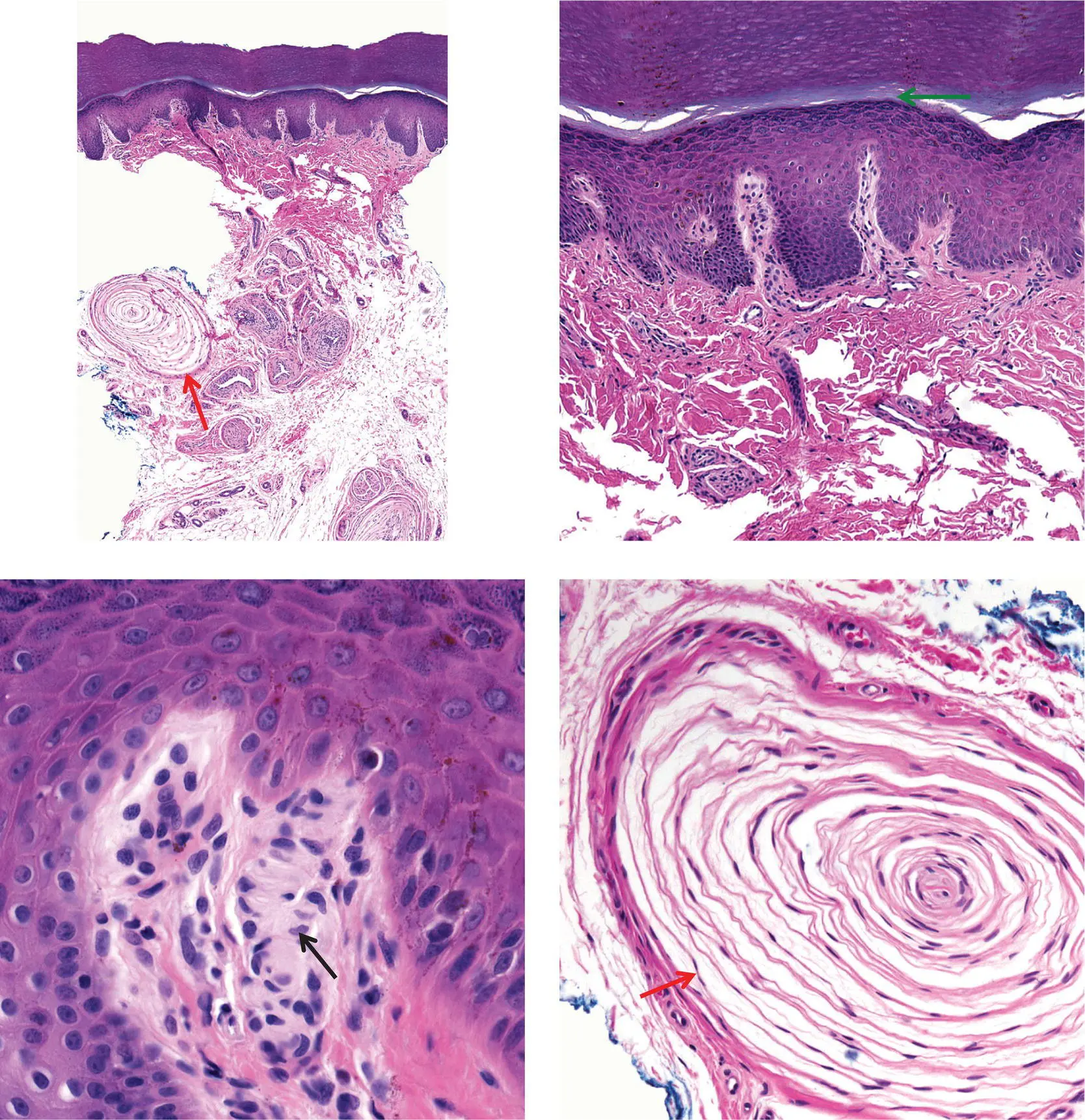 Figure 4AAcral skin NoteMeissners corpuscles black arrow Pacinian - фото 15