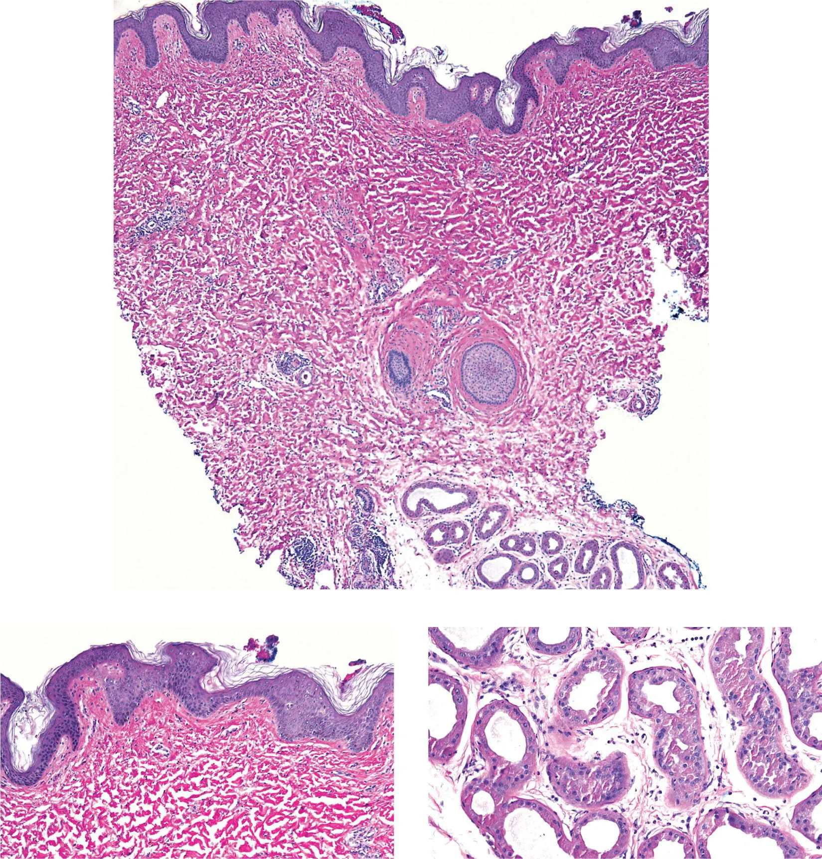 Figure 4DAxilla The epidermis is undulating often with basilar melanin - фото 18