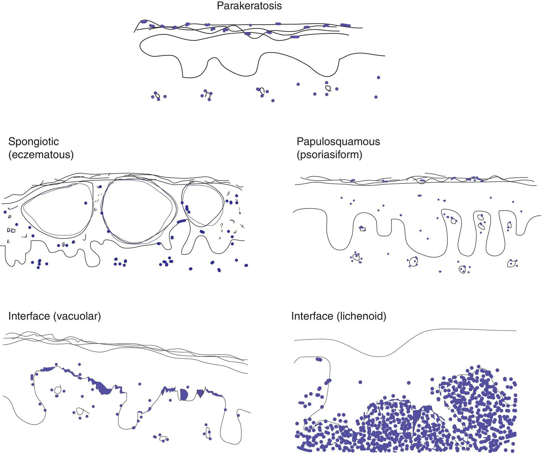 Figure 3A Key epidermal changes Parakeratosis retained nuclei in the stratum - фото 12