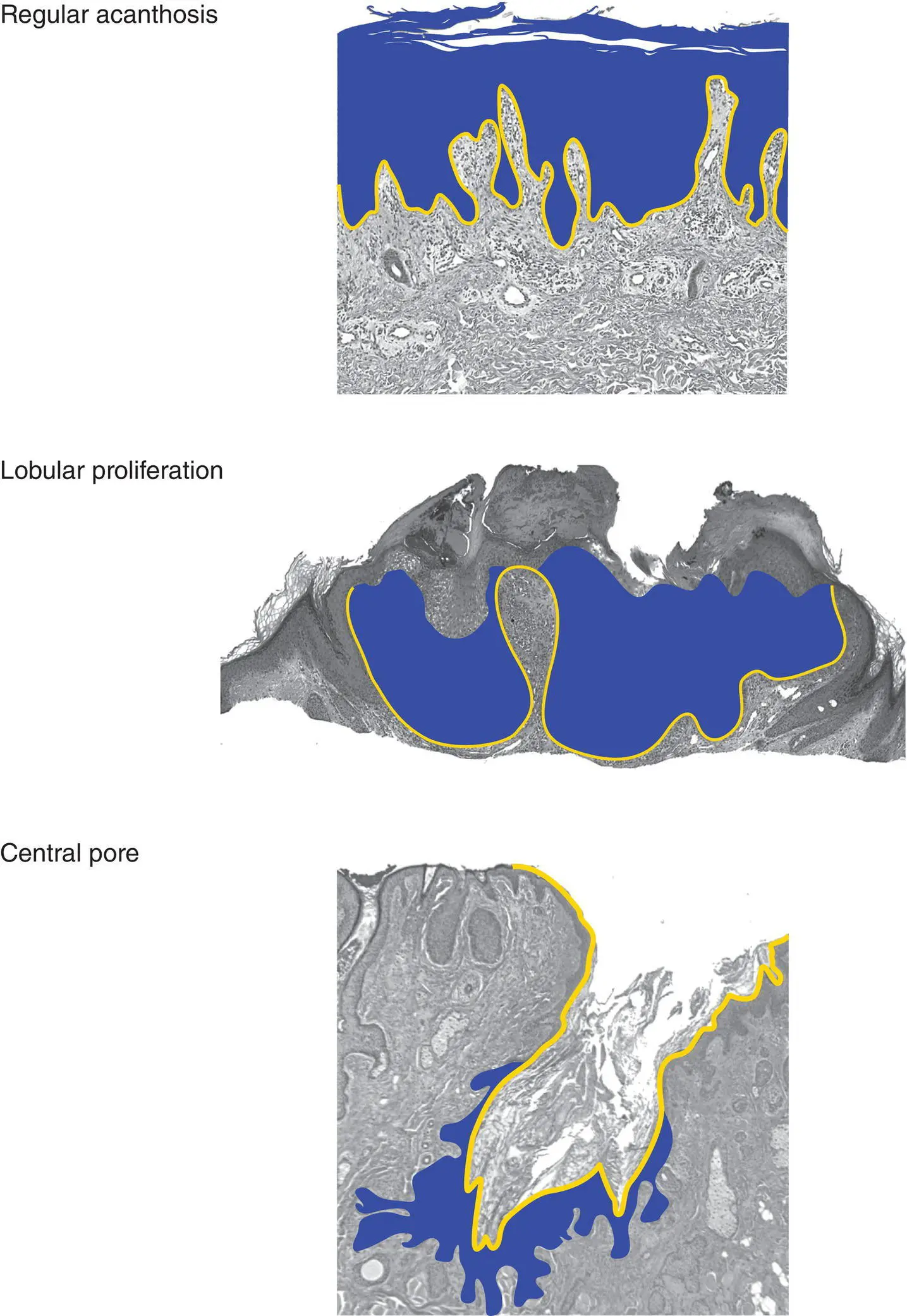 Figure 2BArchitecture of an epidermal tum - фото 5