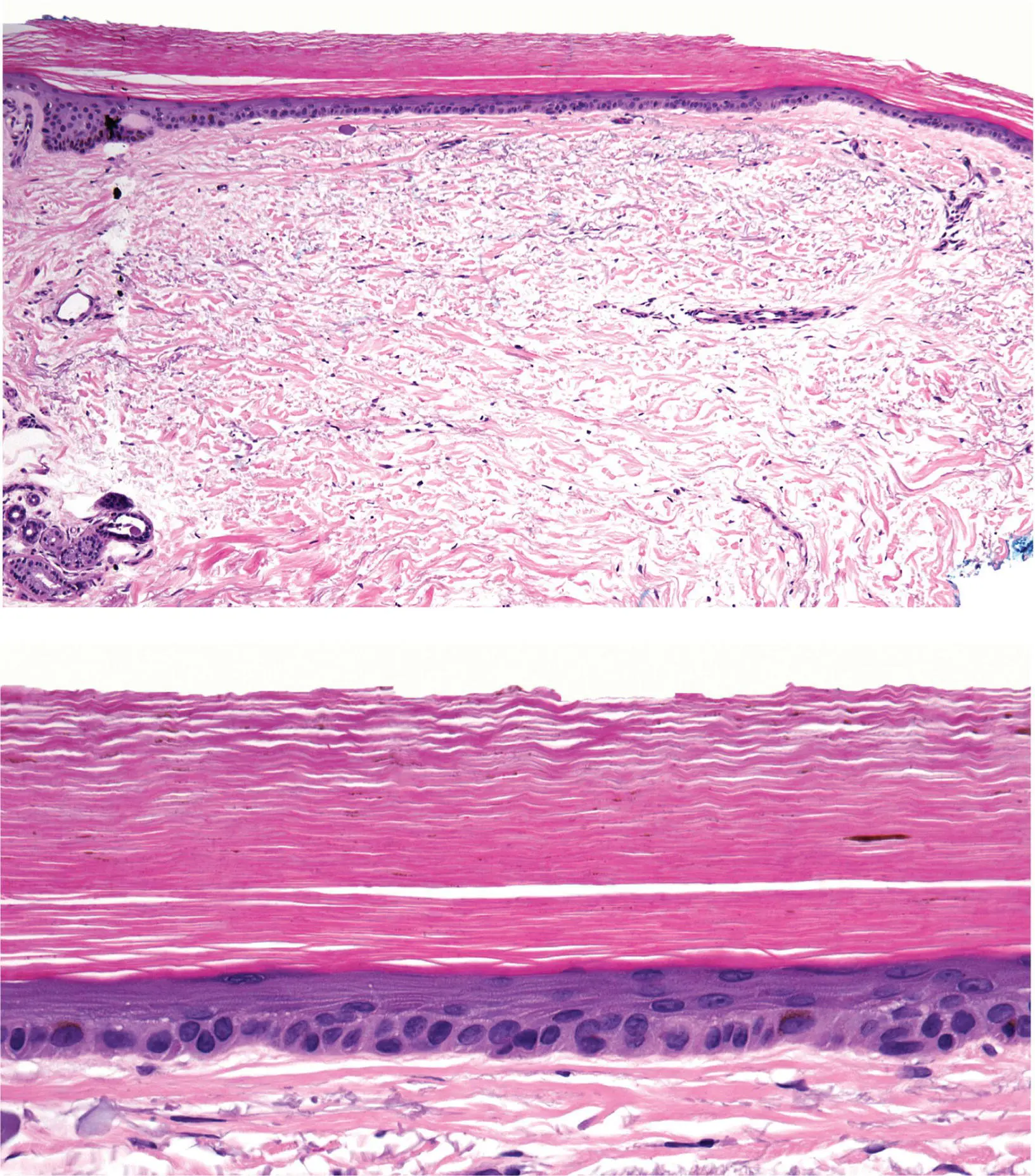 Figure 5B Ichthyosis vulgaris This example from an older patient has solar - фото 20