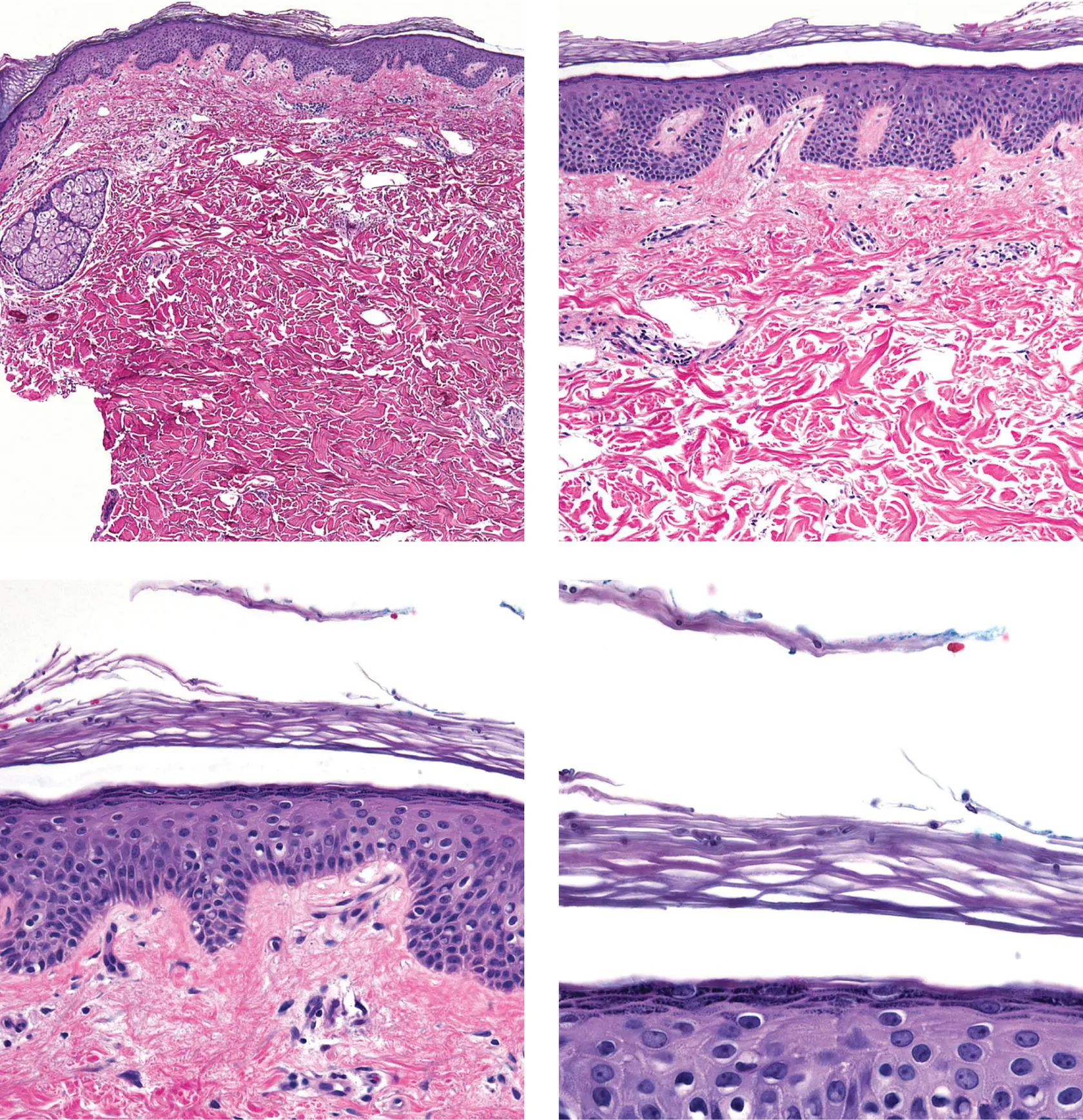 Figure 5C Tinea versicolor Yeast and hyphal forms in the stratum corneum - фото 21