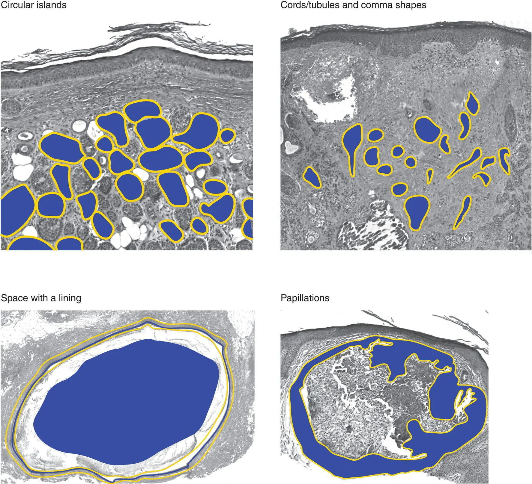 Figure 2BArchitecture of an epidermal tumorprocess Dermal tumors can have - фото 6