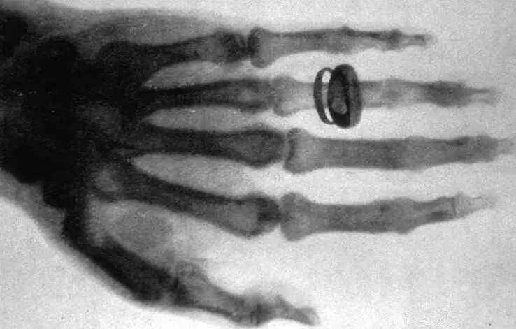 Figure 310 Albert von Köllikers hand photographed by Röntgen These Xrays - фото 21