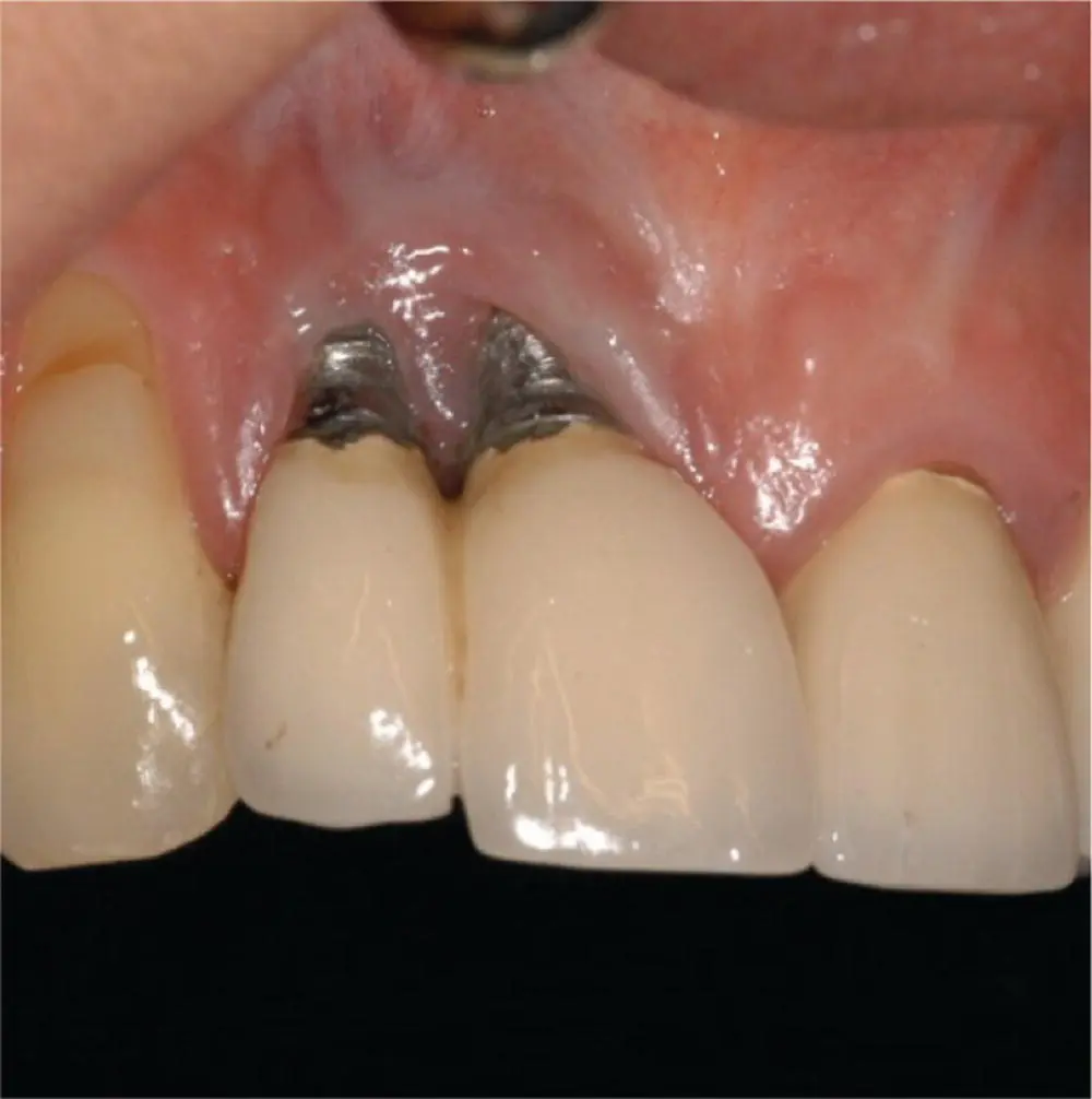 Fig 36 Implants placed too close together compromising gingival esthetics - фото 29