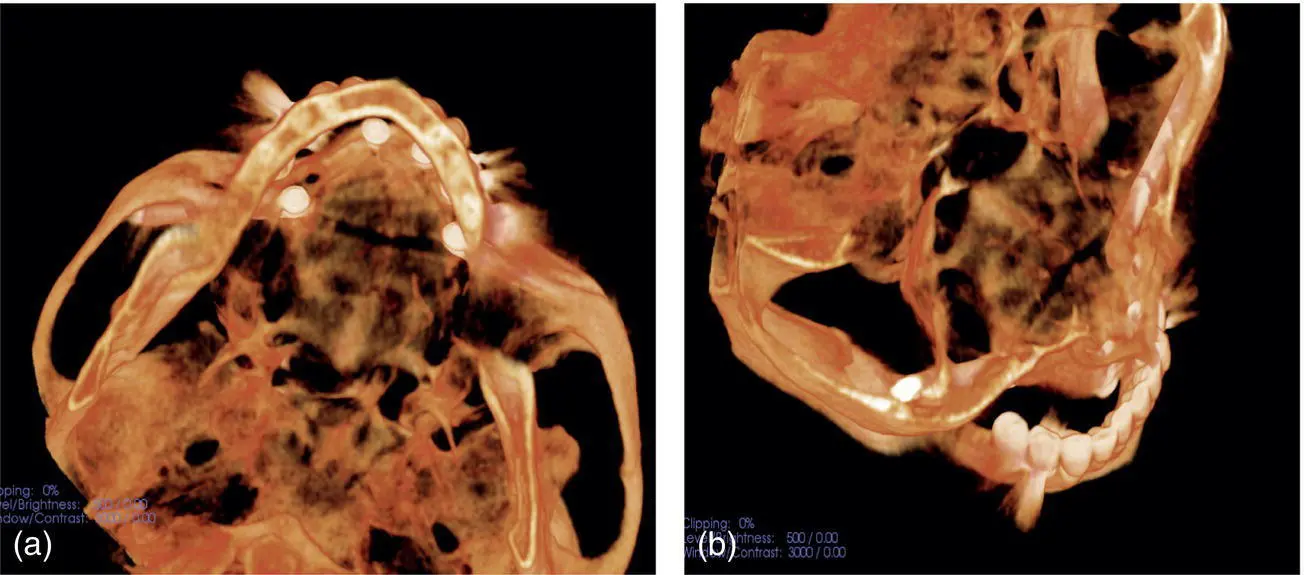 Fig 325 a b Zygomatic implant placed into right infratemporal fossa - фото 55