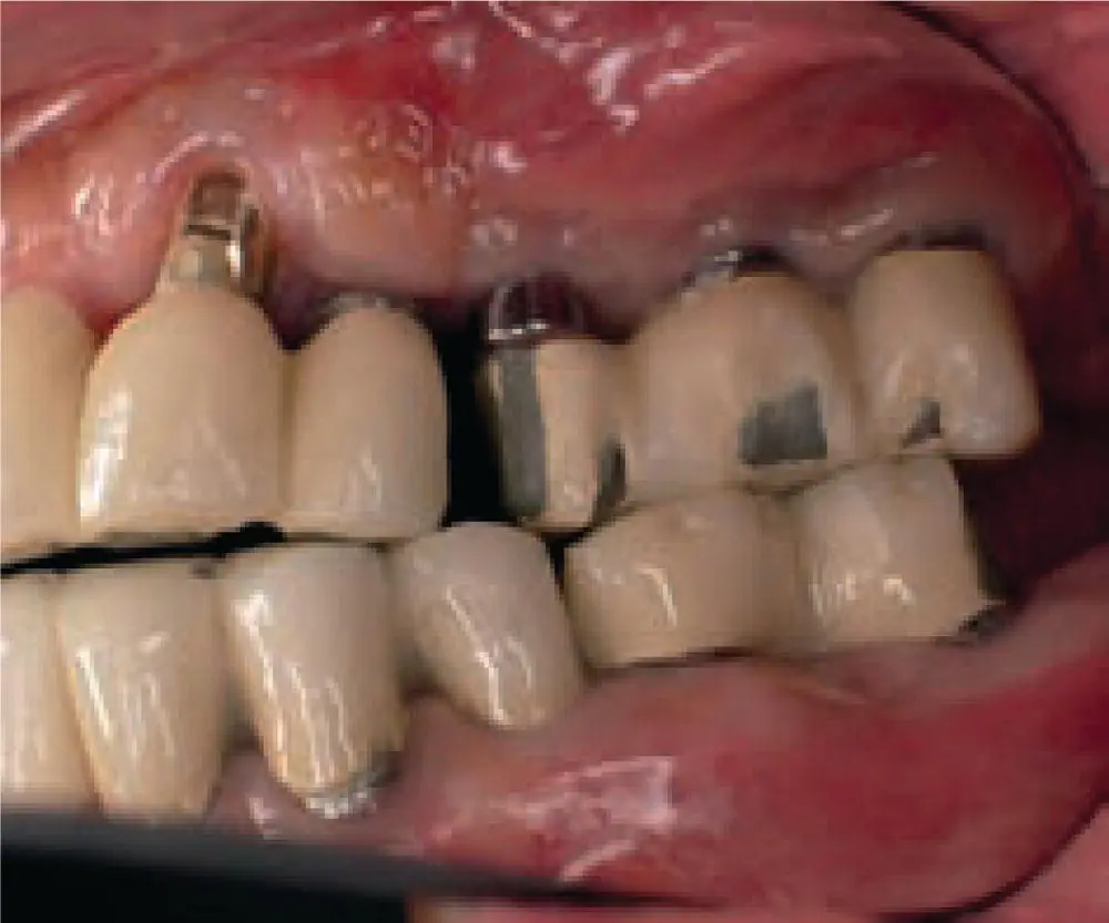 Fig 318 Implant restorative materials fractures Fig 319 Fractured - фото 47