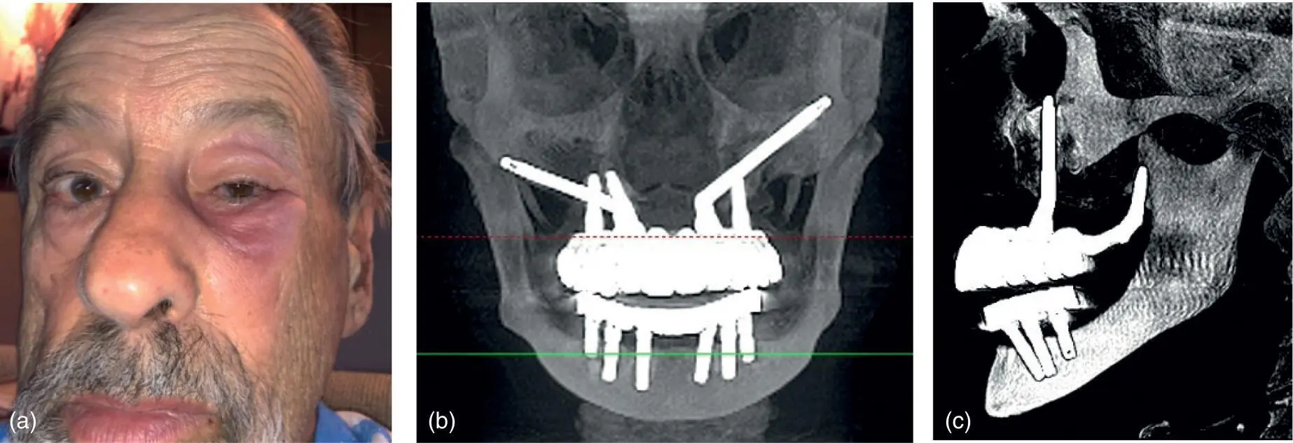 Fig 324 ac Zygomatic implant placed into left orbital cavity causing - фото 54