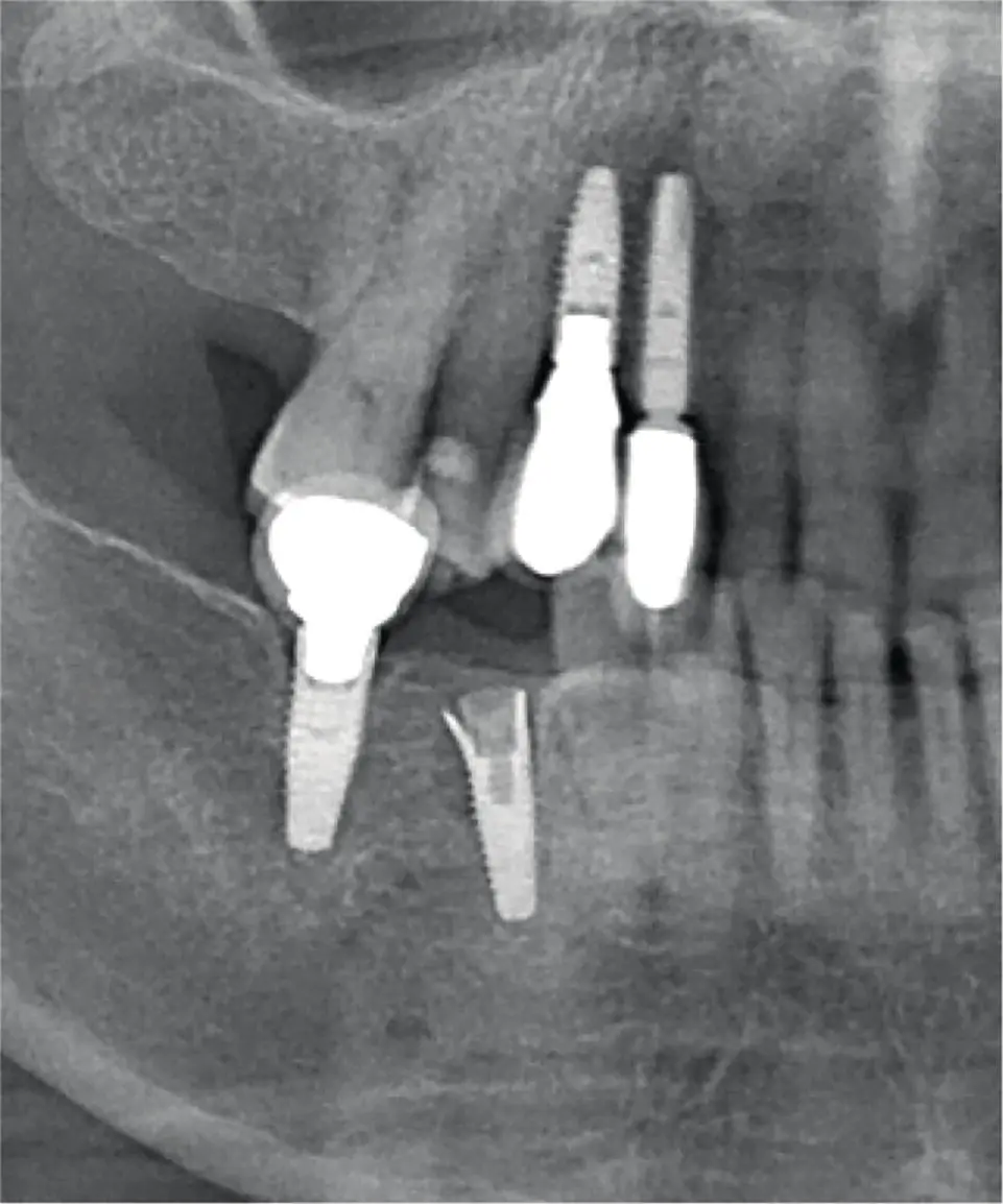 Fig 320 Radiograph of fracture of the actual implant fixture Fig 321 - фото 49