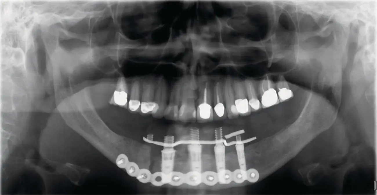 Fig 315 Open reduction with internal fixation of the mandible fracture - фото 42