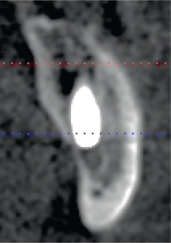 Fig 34 A closer CBCT view of an implant violating the IAC Algorithm 31 - фото 26