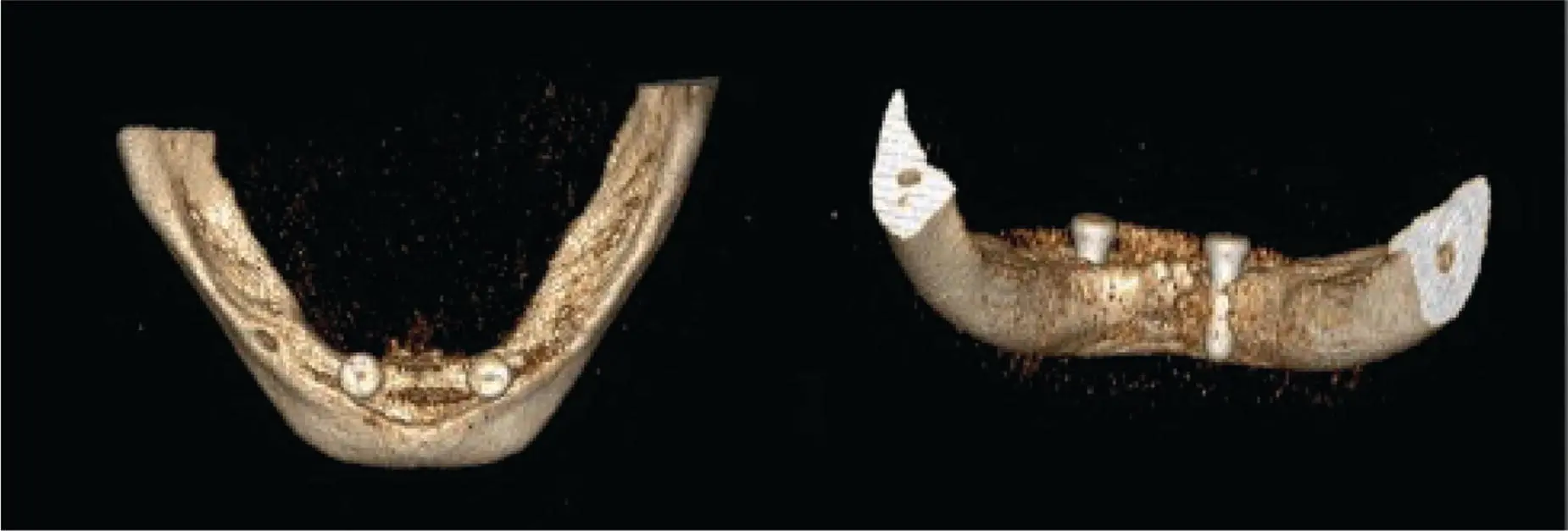 Fig 311 Implant violation of the lingual plate that may transect the - фото 36