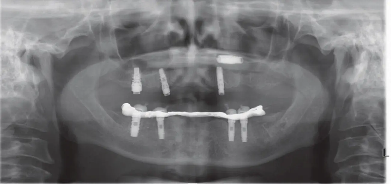 Fig 38 Implant displacement into the left maxillary sinus Fig 39 - фото 32