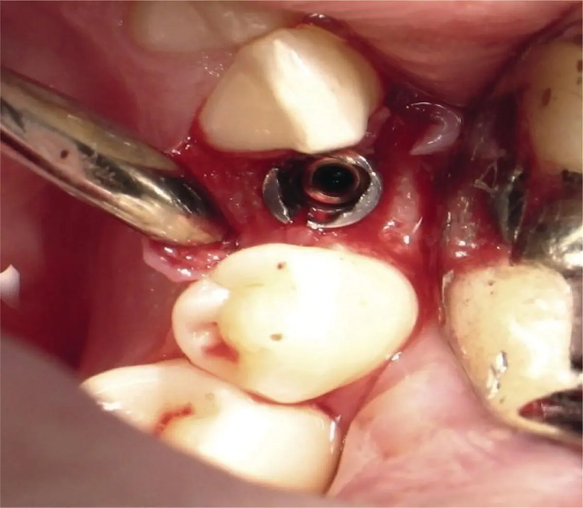 Fig 321 Clinical view of fracture of the actual implant fixture - фото 50