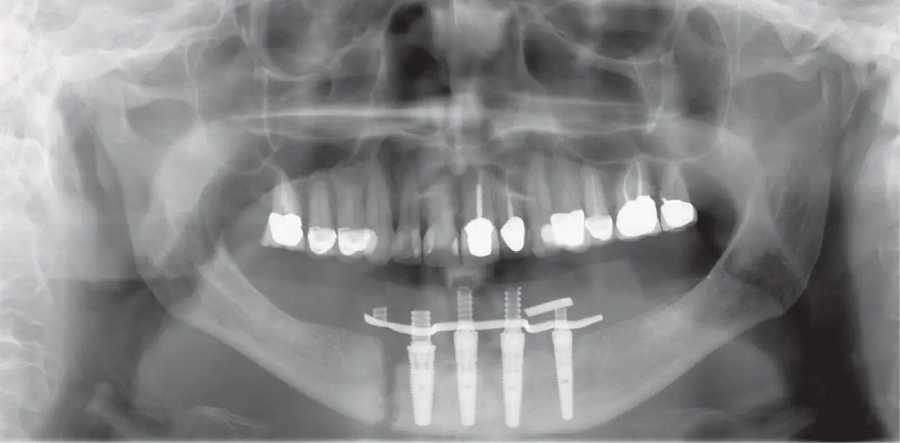 Fig 314 Right mandible fracture from implant placement Algorithm 35 - фото 40