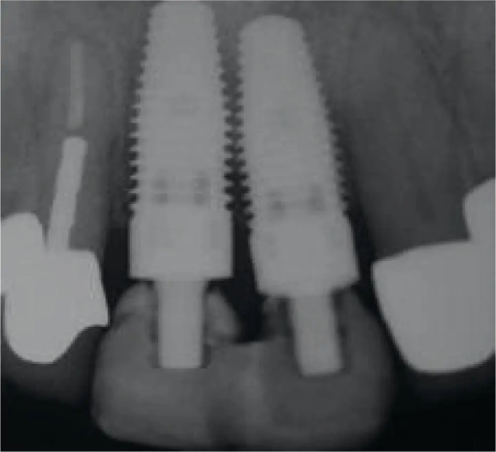 Fig 37 Periapical radiograph showing implants placed too close together - фото 30