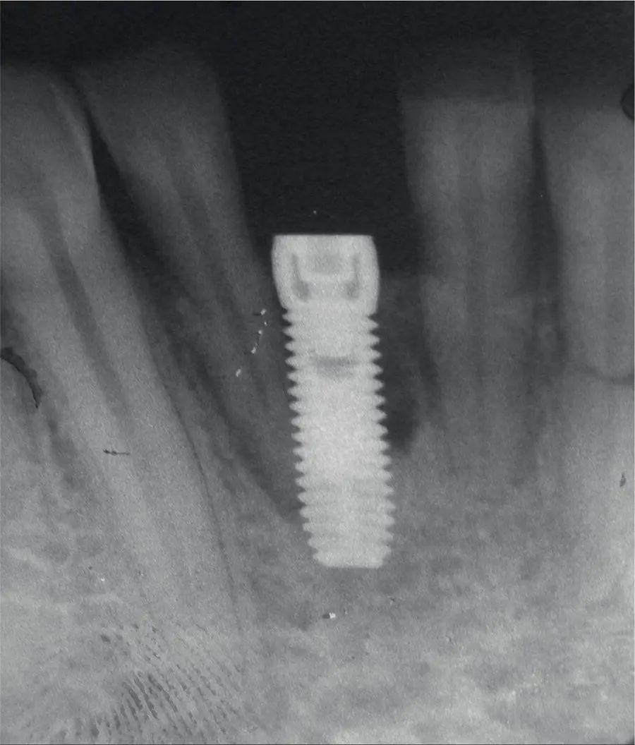 Fig 35 Damage to the adjacent tooth and bone loss due to poor implant - фото 28