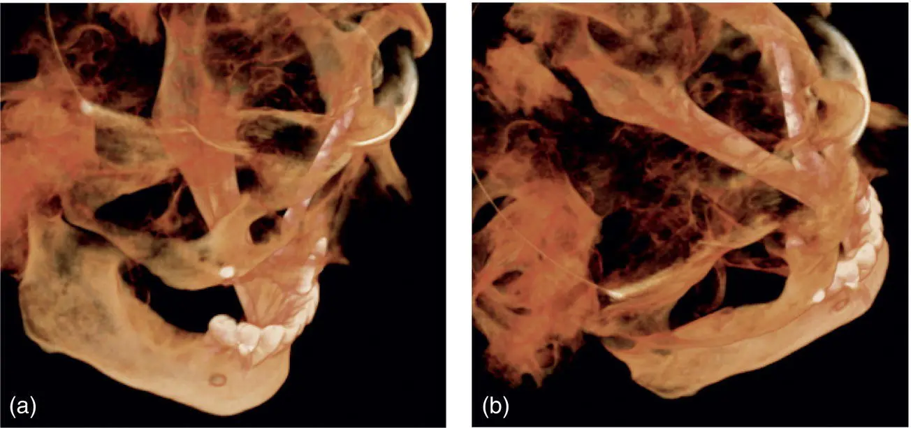 Fig 326 a b Following implant removal and replacement to engage the - фото 56