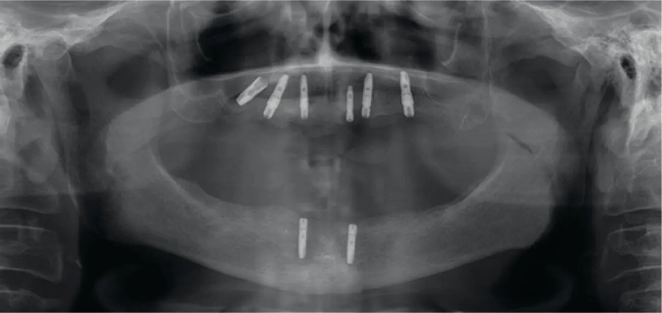 Fig 39 Implant displacement into the right maxillary sinus Dental implant - фото 33
