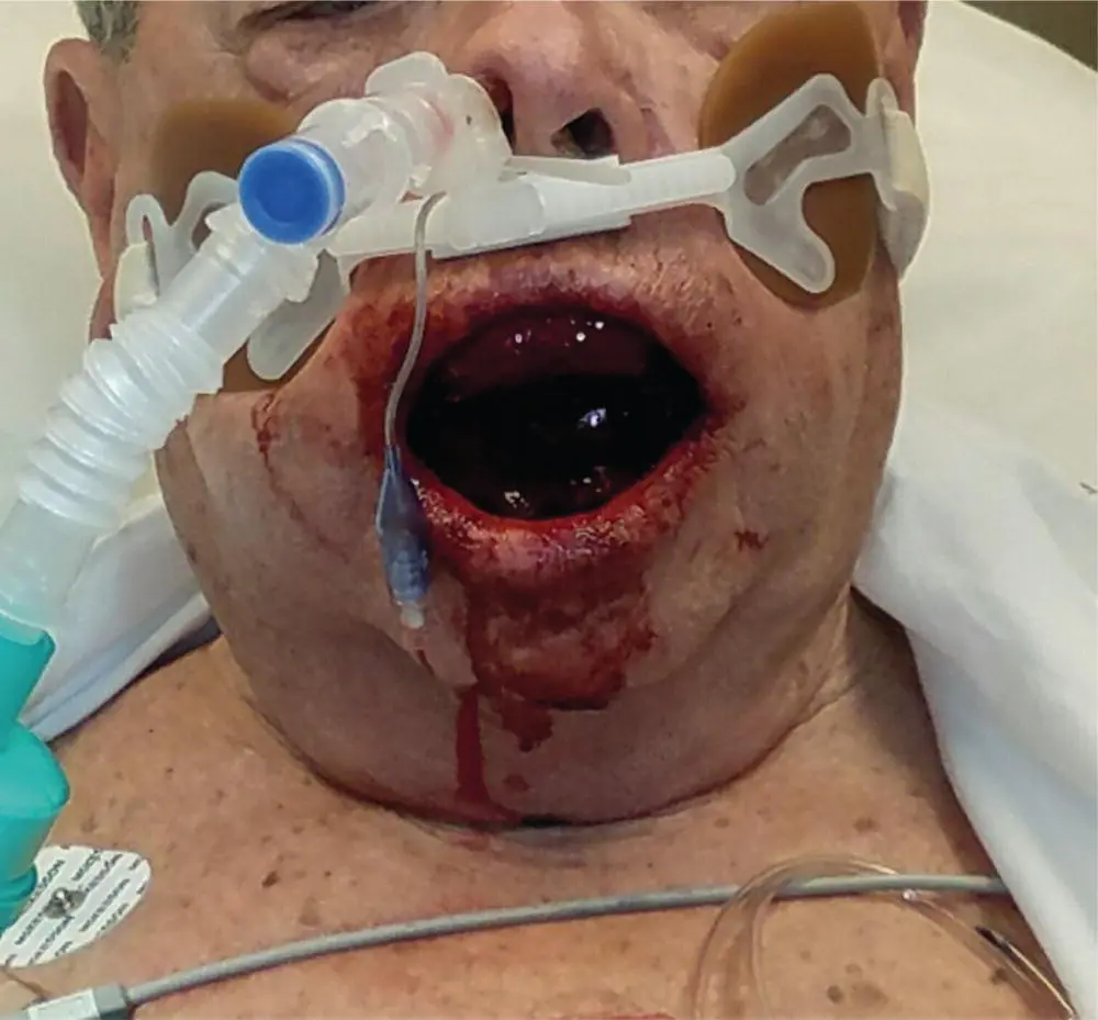 Fig 310 Floor of mouth hematoma following anterior mandible implant - фото 35