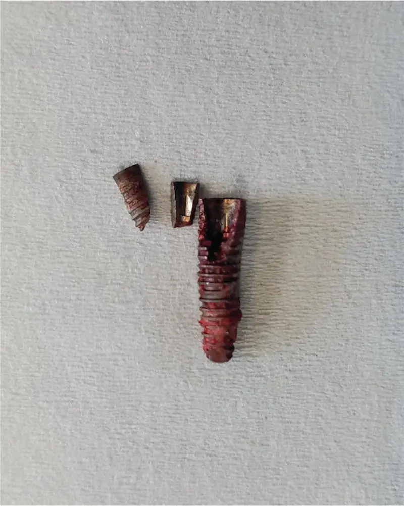 Fig 319 Fractured implant Fracture of the actual surgical implant fixture - фото 48