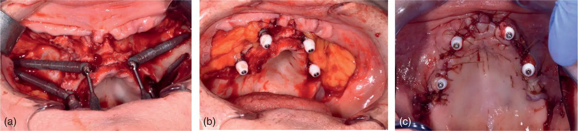 Fig 323 ac Quadzygoma implants with buccal fat pad coverage Fig - фото 53