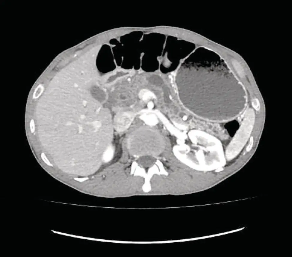 Figure 212 Atrophied pancreas with dilated irregular pancreatic duct and - фото 55