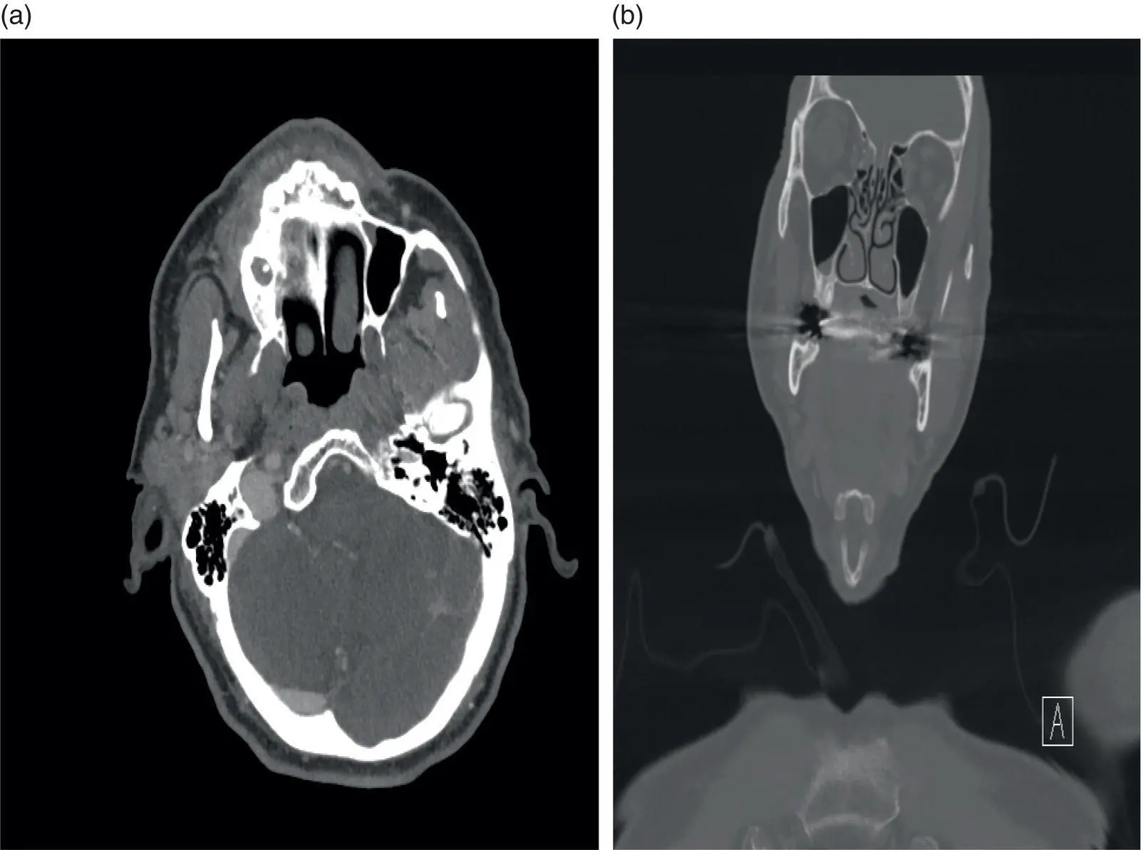 FIGURE 31 Axial a and coronal b cut of the primary lesion Note there is - фото 6