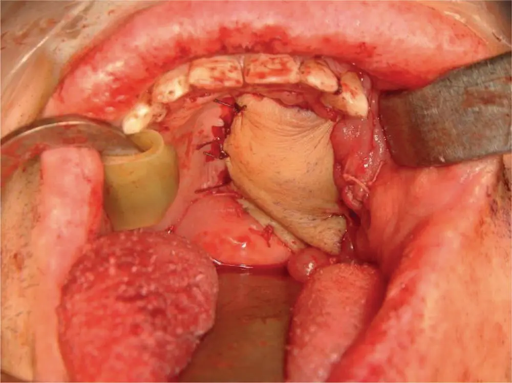 FIGURE 64 This intraoperative photo shows the palate defect after - фото 20