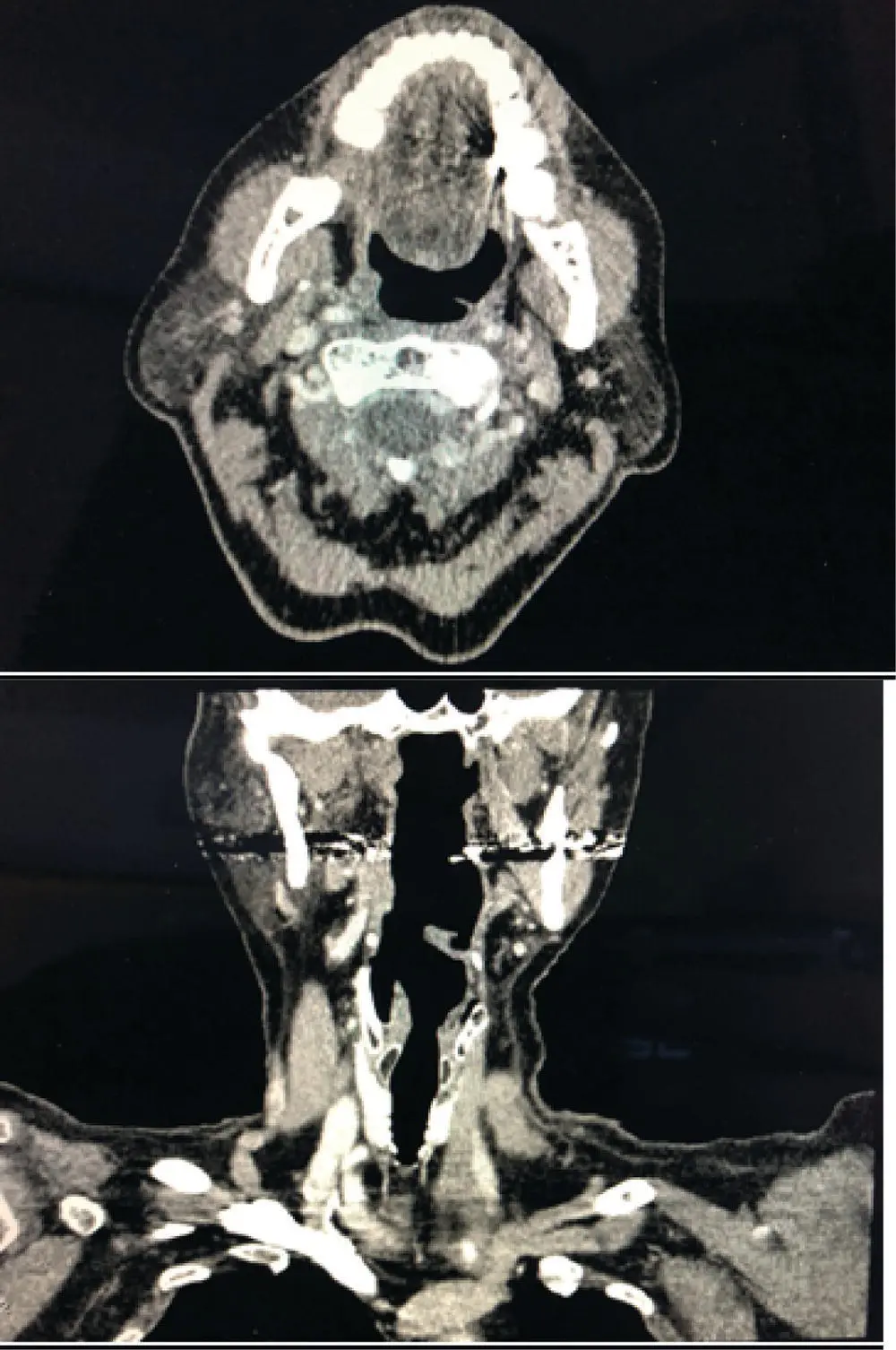 FIGURE 111 A CT of the neck was performed with intravenous contrast There is - фото 26