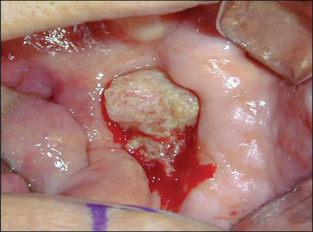 FIGURE 41 This intraoral photograph shows the lesion of the patients left - фото 9