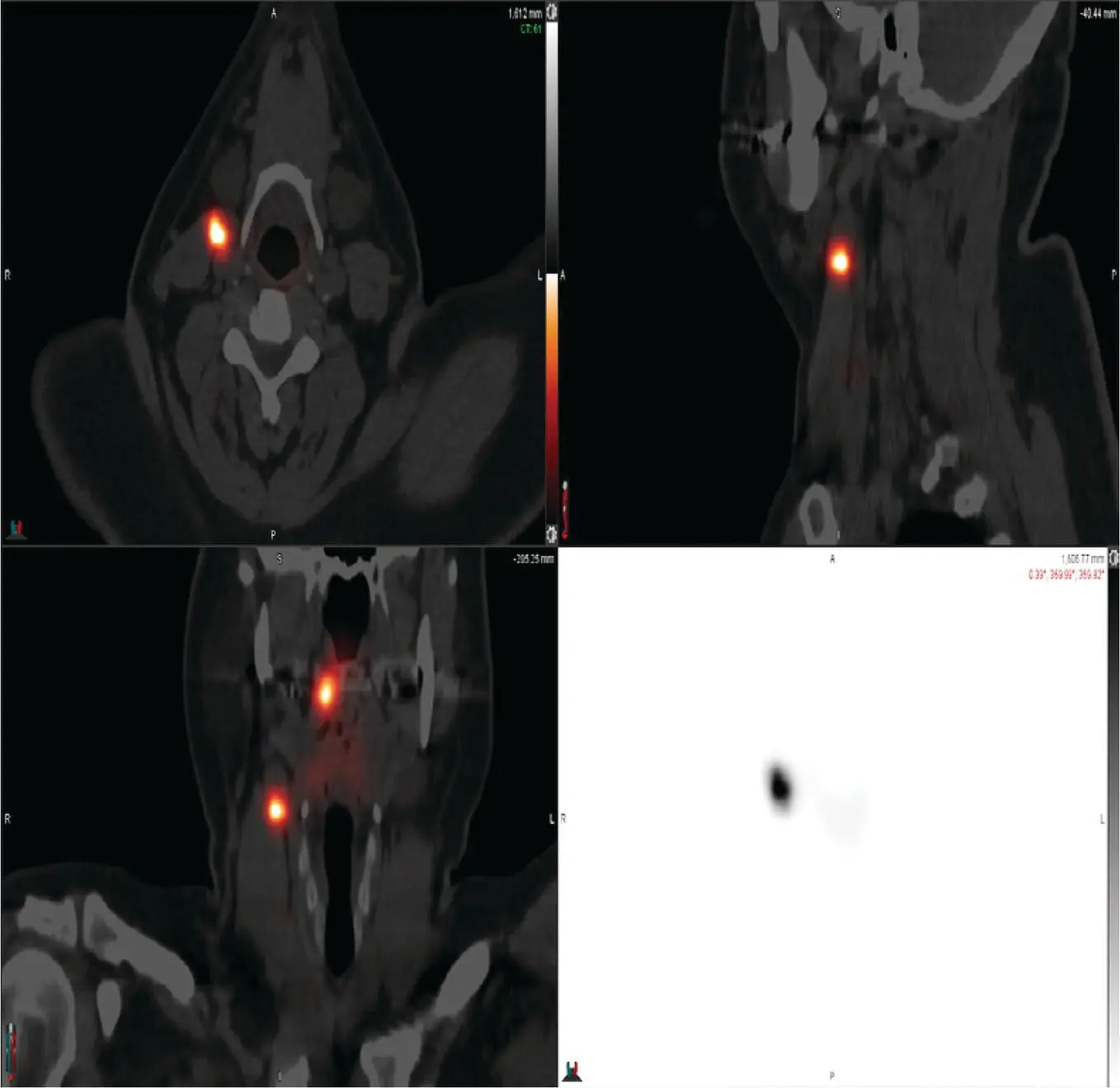 FIGURE 12 This image shows the patients fused CT lymphoscintigraphy image - фото 3